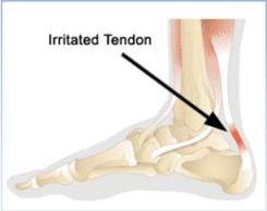 irritated-tendon
