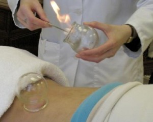 Barbican Acupuncture cupping
