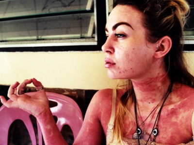 Meet the woman facing psoriasis head on | Challenging body image perceptions (F)