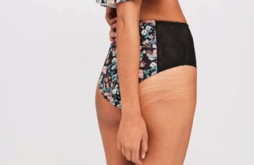missguided stretchmarks
